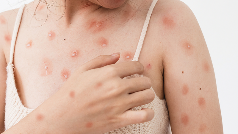 Monkeypox: What Pharmacists Should Know and Can Do