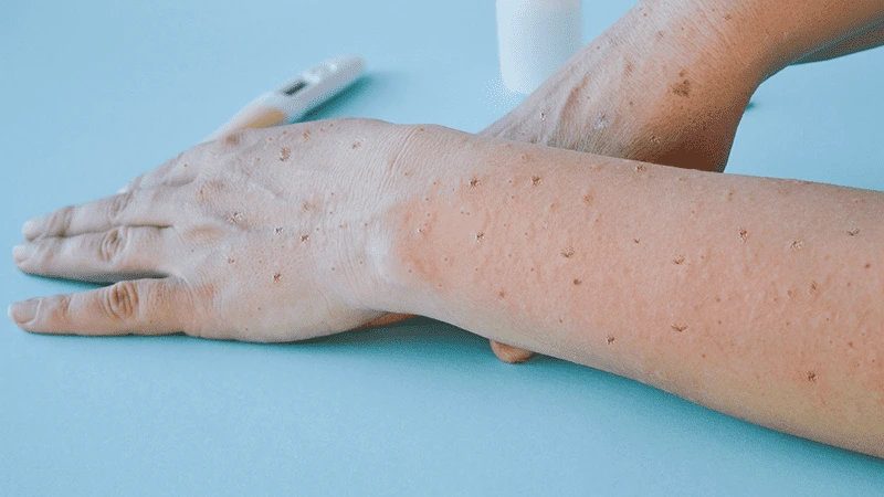 What You Need to Know About Mpox, Previously Known as Monkeypox