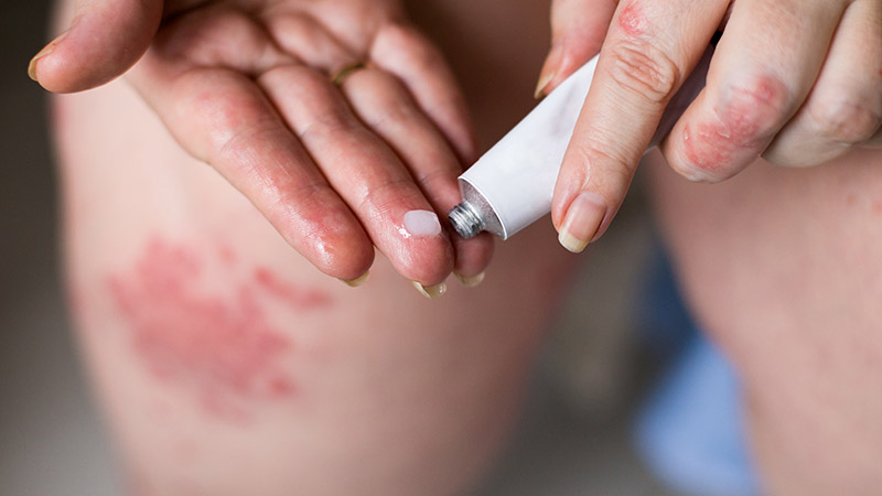 How Do You Treat Eczema