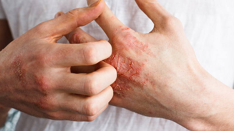 How to Know if You Have Eczema