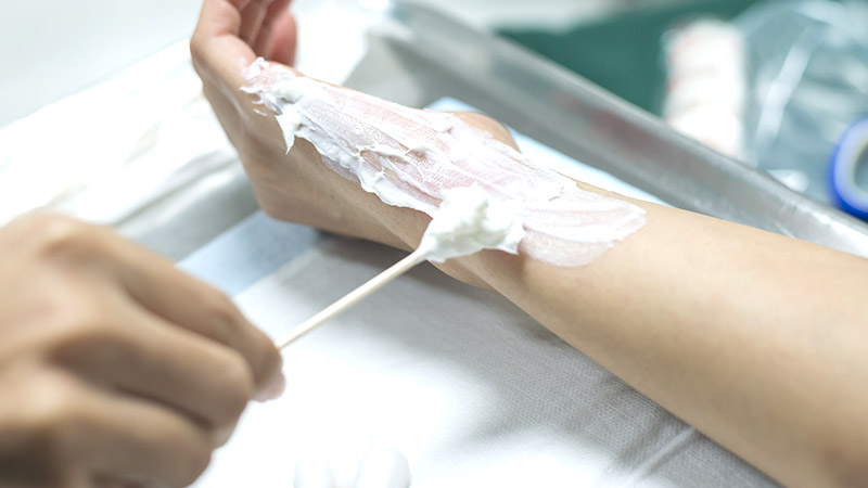 How to Treat and Prevent Minor Burns