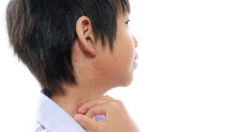 Measles 101: How to Know if You Are Infected