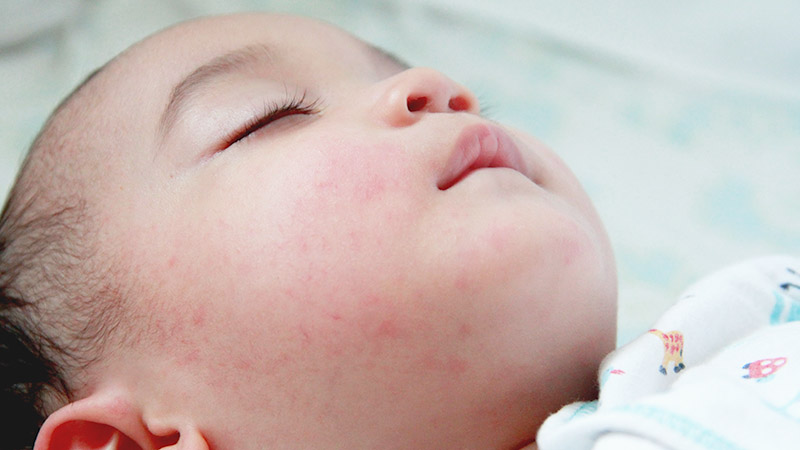 What You Need To Know About Dengue Fever