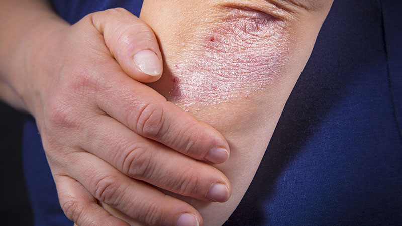 What is Psoriasis and Do I Have It