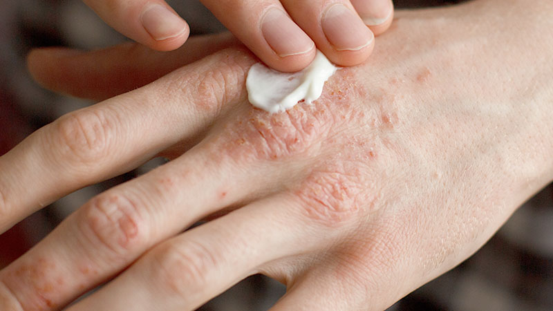 What is Psoriasis and How Can I Treat It