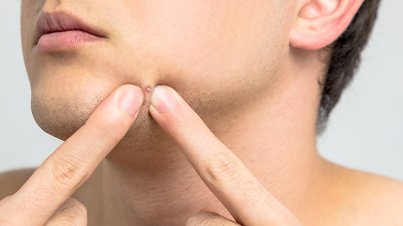 What to Do When You Have Acne