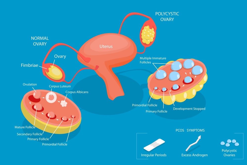 Polycystic Ovary Syndrome (PCOS)